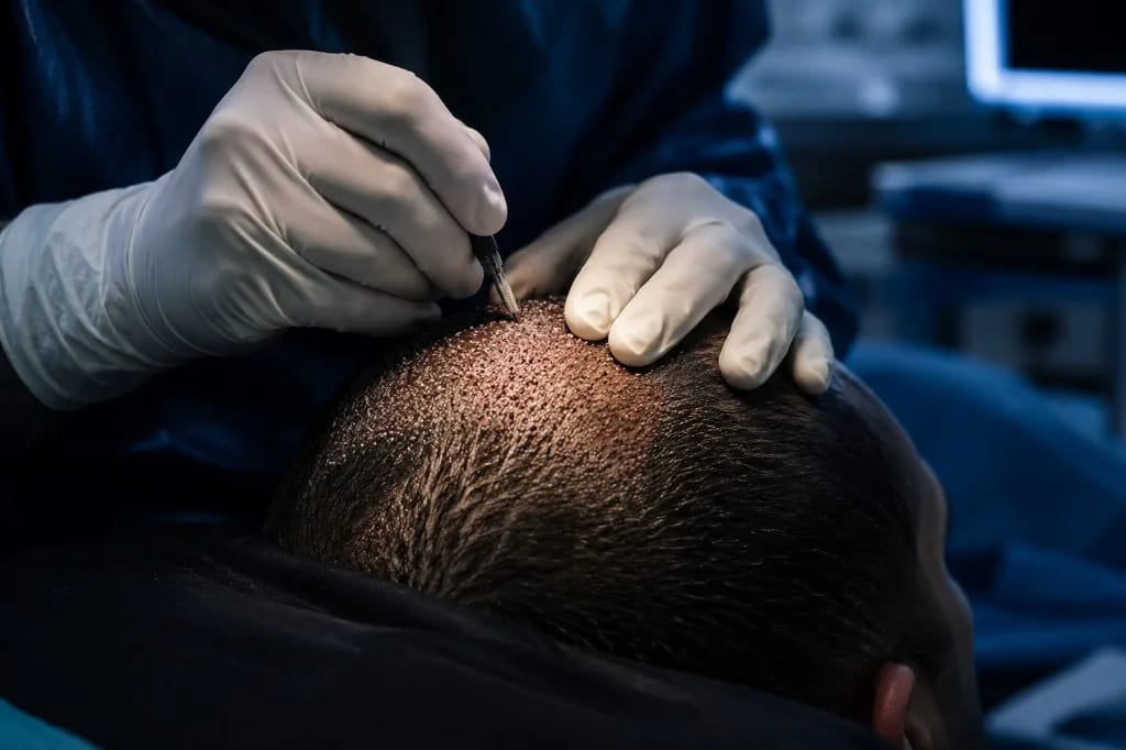 Micro-punch FUE hair transplant procedure in progress