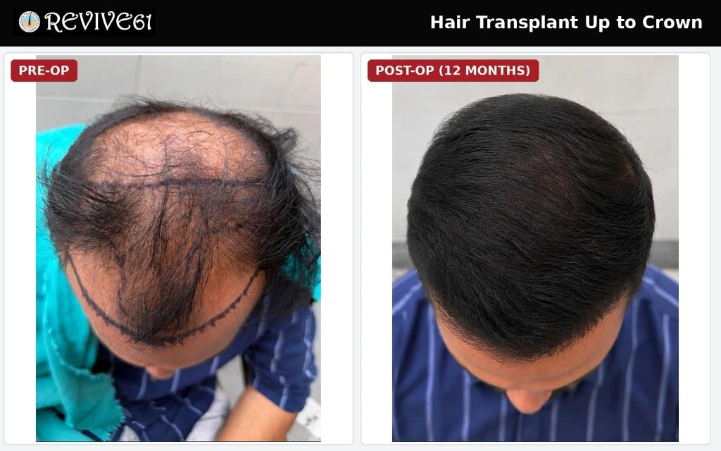 Hair transplant up to crown — 12 months post-op at Revive61