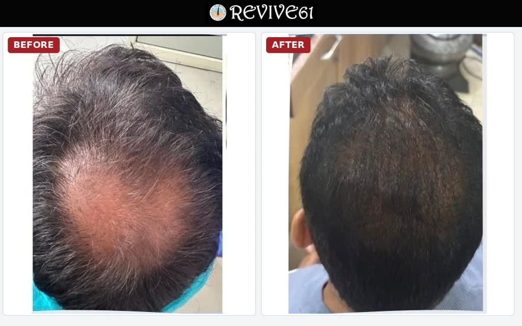 Hair transplant before and after — crown density improvement at Revive61