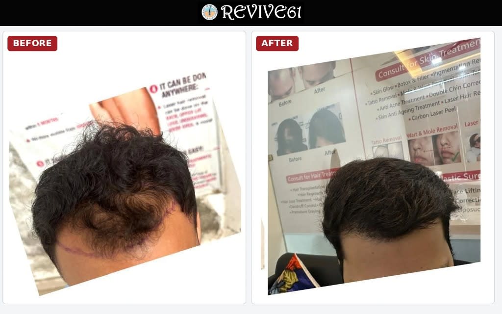 Hair transplant before and after — frontal and crown coverage at Revive61