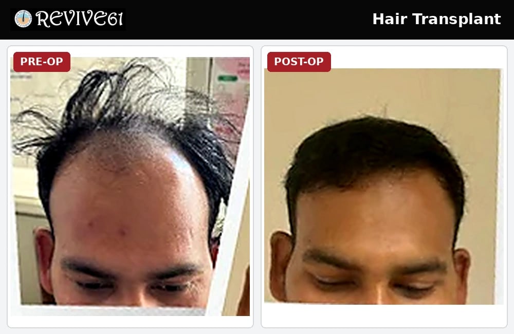 Hair transplant hairline before and after at Revive61 Faridabad