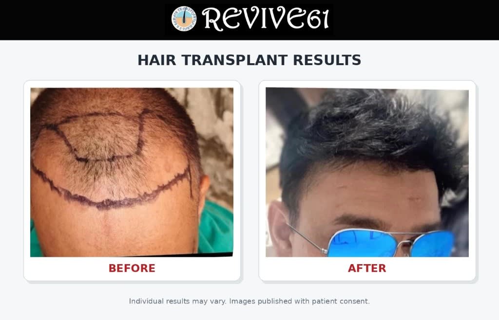 Hair transplant results overview — before and after at Revive61 Faridabad