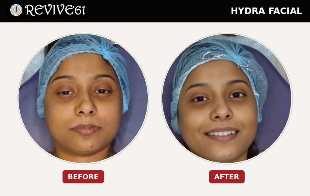 Hydra Facial before and after at Revive61 Faridabad