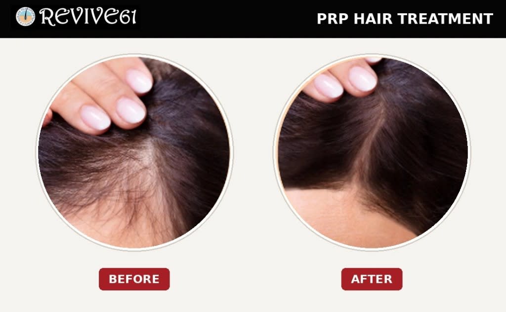 PRP hair treatment before and after at Revive61 Faridabad