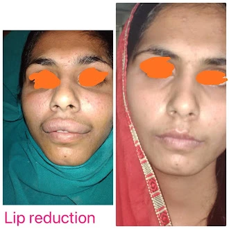 Lip reduction surgery before and after at Revive61 Faridabad