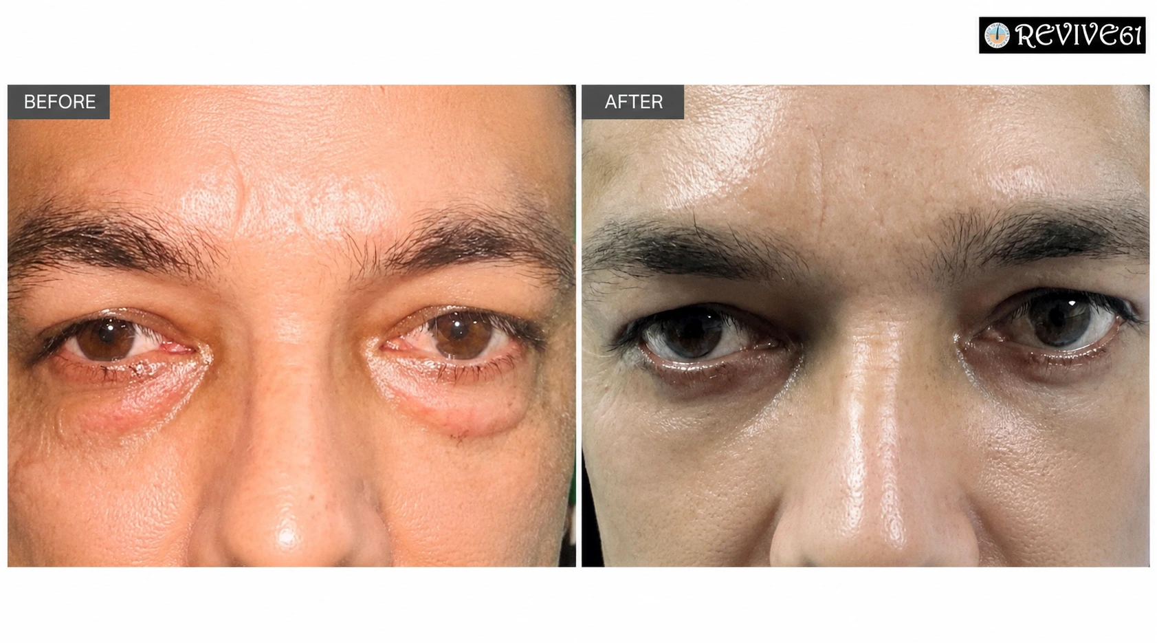 Blepharoplasty before and after — under-eye fat bags at Revive61 Faridabad