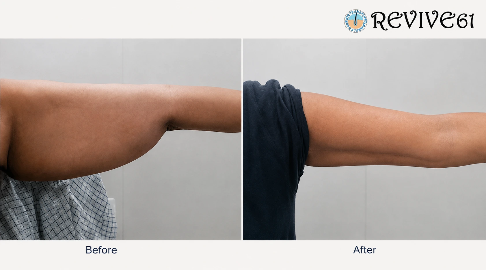 Brachioplasty arm lift before and after at Revive61 Faridabad