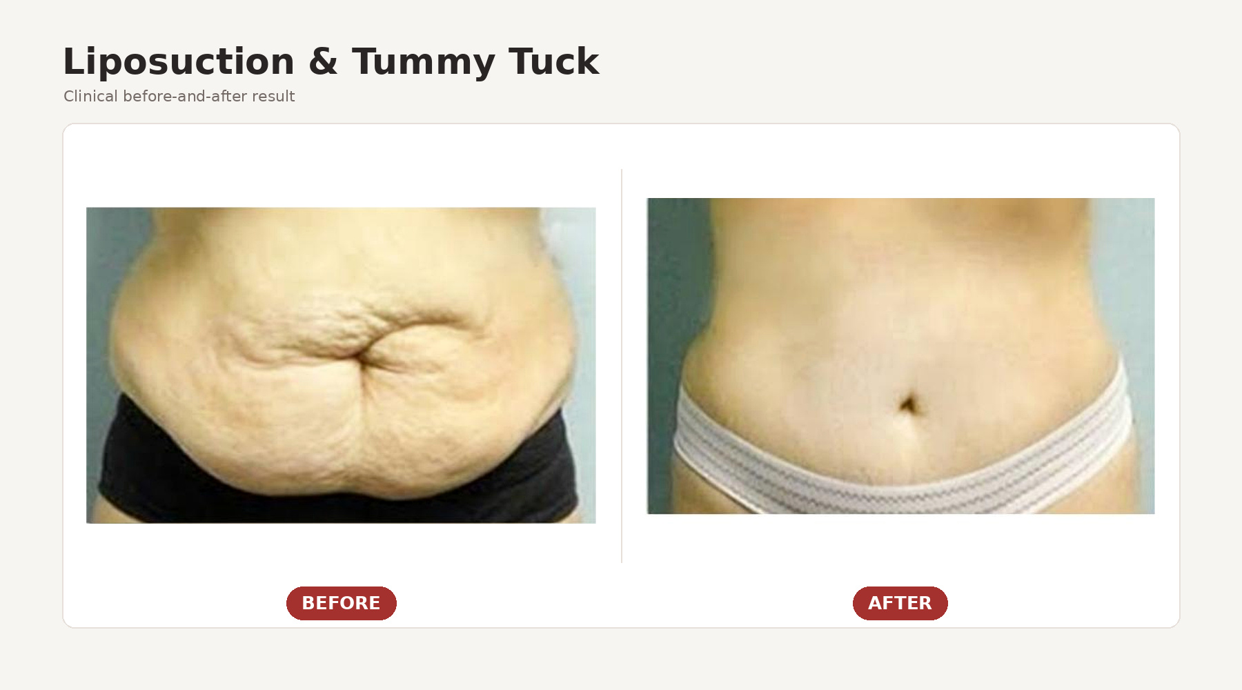 Liposuction and tummy tuck before and after at Revive61 Faridabad