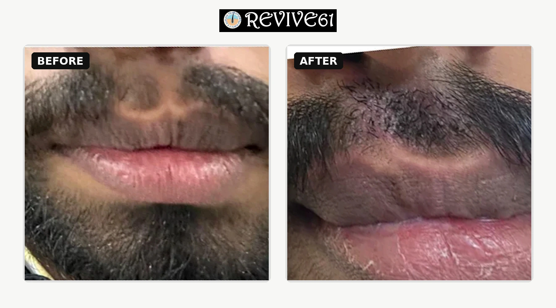 Moustache hair transplant before and after at Revive61 Faridabad