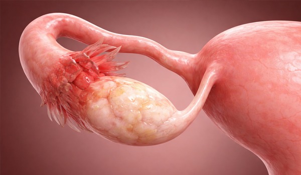 Blocked Fallopian Tubes
