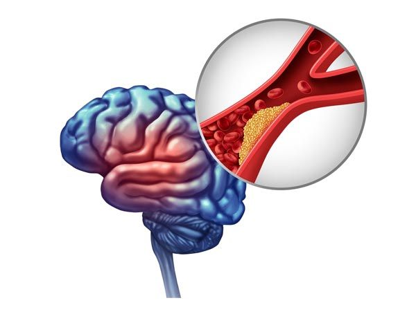 Gambar Sumbatan Aliran Darah ke otak penyebab stroke ringan