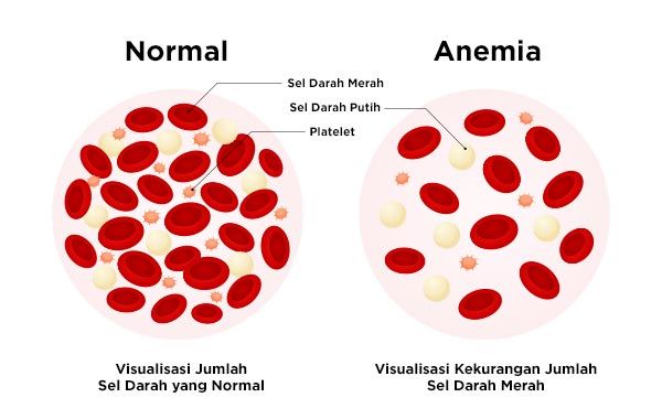 Anemia