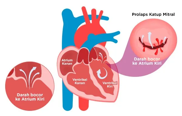 Prolaps Katup Mitral