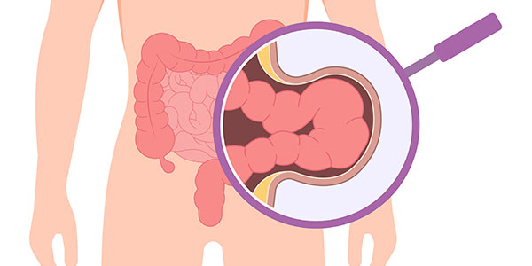 Gambar Hernia
