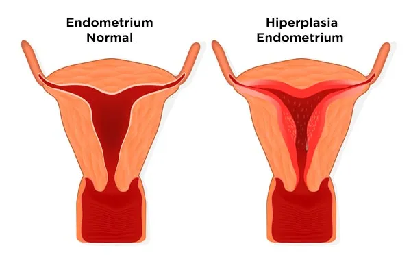 Gambar Penebalan Dinding Rahim / Hiperplasia Endometrium