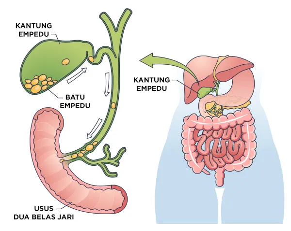 Gambar Batu Empedu