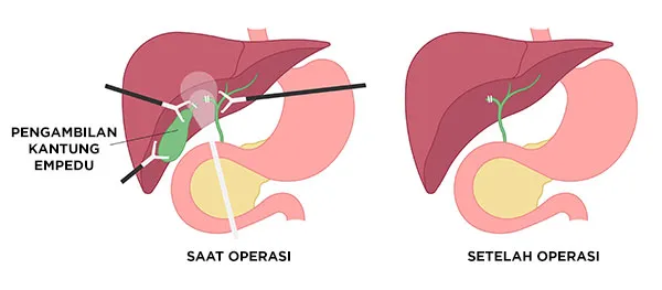Prosedur Open Cholecystectomy