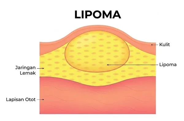 Visualisasi Lipoma