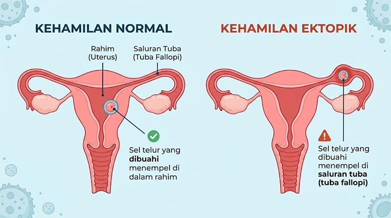 Gambar Organ Kehamilan Ektopik