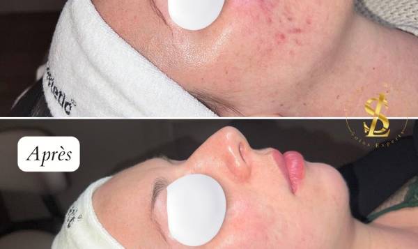 Centre LS - Soins experts à Dijon - Jetpeel, Radiofrequence & LED