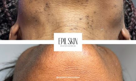 Epilskin : Institut de beauté à Saint-Maur-des-Fossés