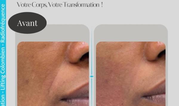 Carole Lipocavitation 