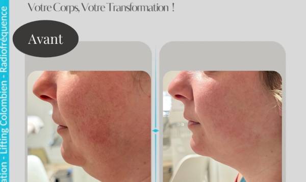 Carole Lipocavitation 