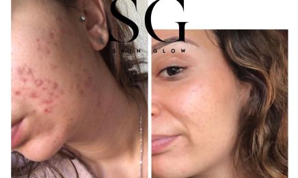 Skin Glow | Soins du visage | Épilation définitive par Électrolyse | Épilation Laser : Manucure à Toulouse