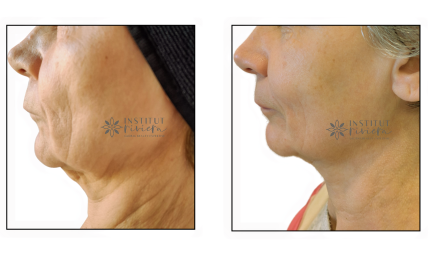 Institut Riviera | Expertise Epilation Définitive Electrolyse, Anti Age et Minceur : Institut de beauté à Antibes