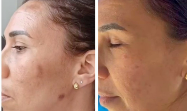 Promesse Clinic - épilation laser définitive - fil de collagène - lifting coréen