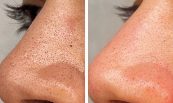 Promesse Clinic - épilation laser définitive - fil de collagène - lifting coréen