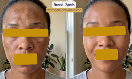 Melaskinxcare - Skin thérapeute & Esthéticienne experte peaux noires  : Institut de beauté à Villejuif
