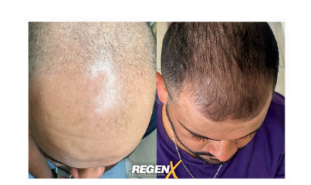 Fano Dermo - RegenX kelen bauck : Institut de beauté à Cancale