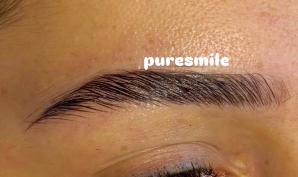 Promesse Clinic - épilation laser définitive - fil de collagène - lifting coréen