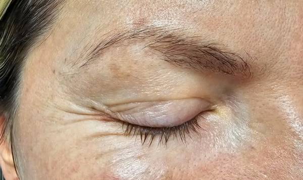 Carole Lipocavitation 