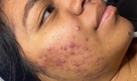 Skin GLOW Muret |  Électrolyse | Laser Candela : Institut de beauté à Muret