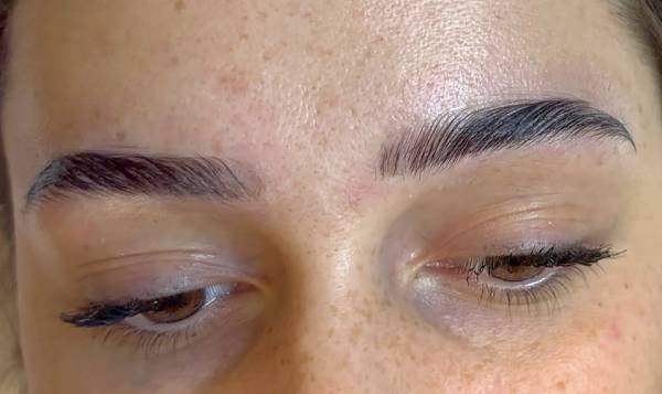 Promesse Clinic - épilation laser définitive - fil de collagène - lifting coréen