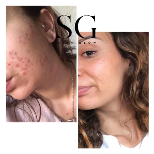 Skin Glow | Soins du visage | Épilation définitive par Électrolyse | Épilation Laser - Barbier Toulouse - Skin Glow | Soins du visage | Épilation définitive par Électrolyse | Épilation Laser - Photo Galerie - OneBooking