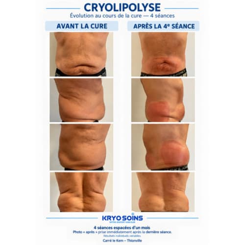 Kryo Soins - Institut de beauté Thionville - Kryo Soins - Photo Galerie - OneBooking