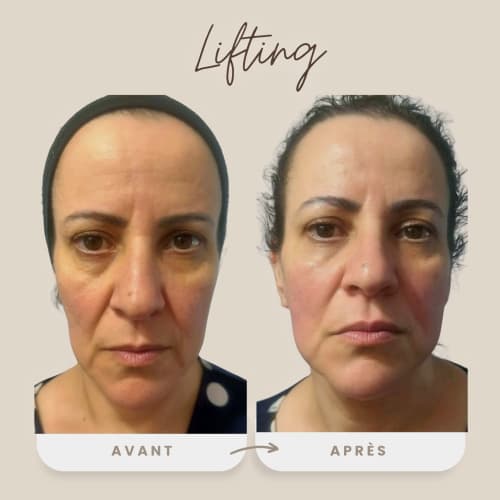 KEATHERAPIE - DRAINAGE LYMPHATIQUE / SOIN POST OPERATOIRE - Institut de beauté Lyon - KEATHERAPIE - DRAINAGE LYMPHATIQUE / SOIN POST OPERATOIRE - Photo Galerie - OneBooking