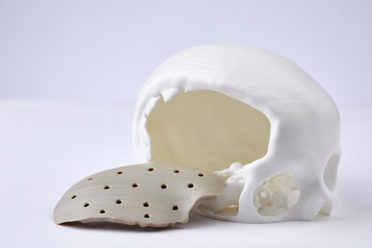 5-3d-printed-cranial-implant