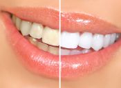 Tips para blanquear tus dientes en casa