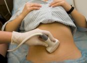 Ovarios poliquísticos: común pero desconocido síndrome