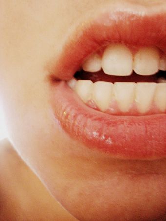 Blancorexia: la obsesión por los dientes blancos