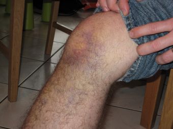 Mi lesión: Esguince de rodilla