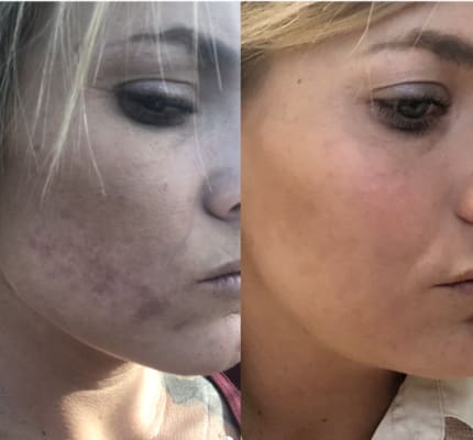 Clear Anti Redness Exfoliating Solution 2 Salicylic Acid Paula S Choice