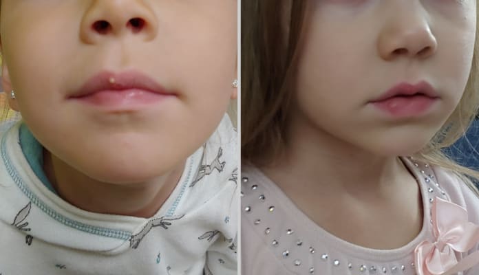 paula's choice spot treatment acne