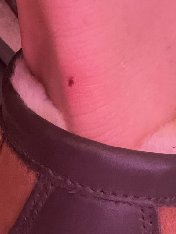 Customer Image Captioned: Foot damage from shoe rubbing