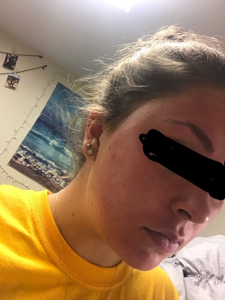 my face after 20 minutes of taking off the mask