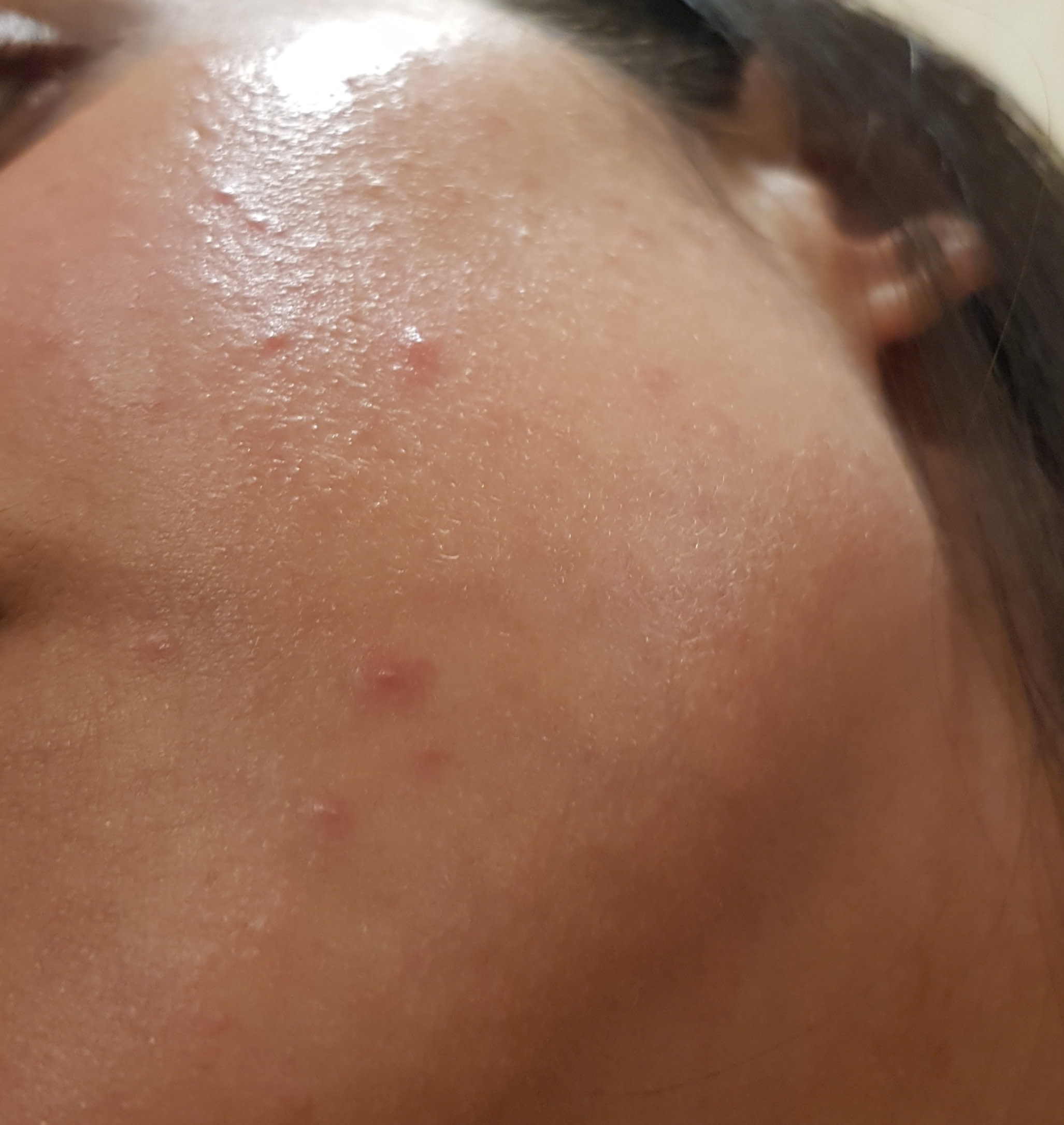 I usually don't have any pimples and my skin is usually clear.